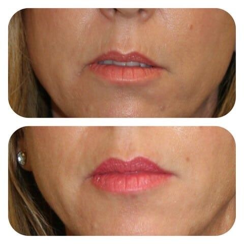 Real lip filler before and after, a De Luz Medical Aesthetics patient