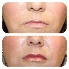 Real lip filler before and after, a De Luz Medical Aesthetics patient