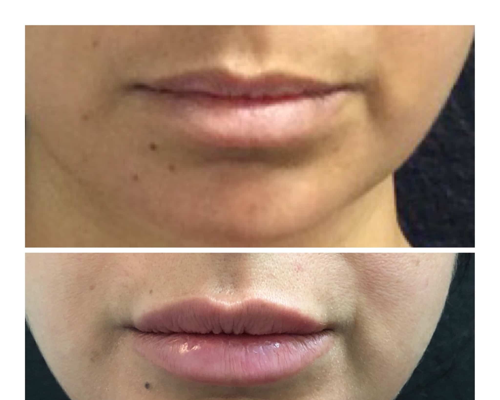 Real lip filler before and after, a De Luz Medical Aesthetics patient