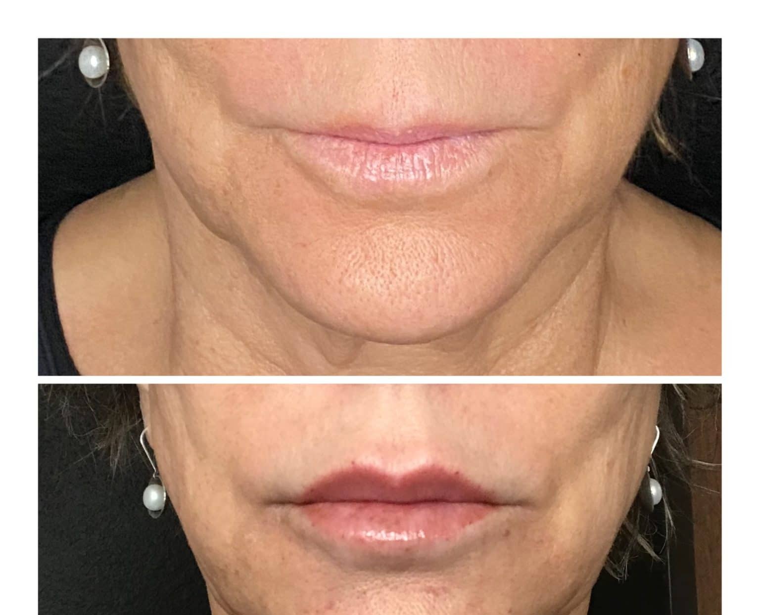 Real lip filler before and after, a De Luz Medical Aesthetics patient